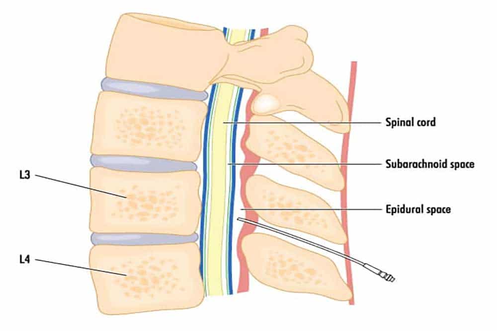 medical illustration of epidural steroid injections