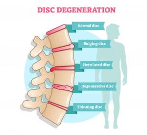 poster of Disc Degenerative