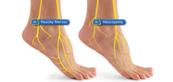 The Dangers Of Untreated Diabetic Neuropathy