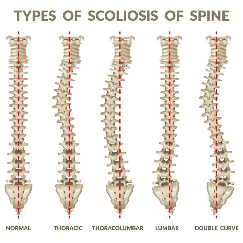 Skeletal representation of a scoliosis