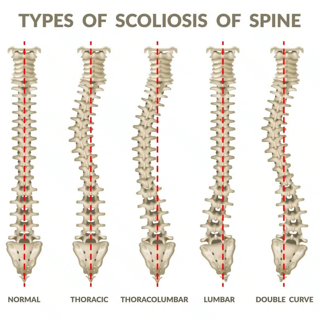 Skeletal representation of a scoliosis