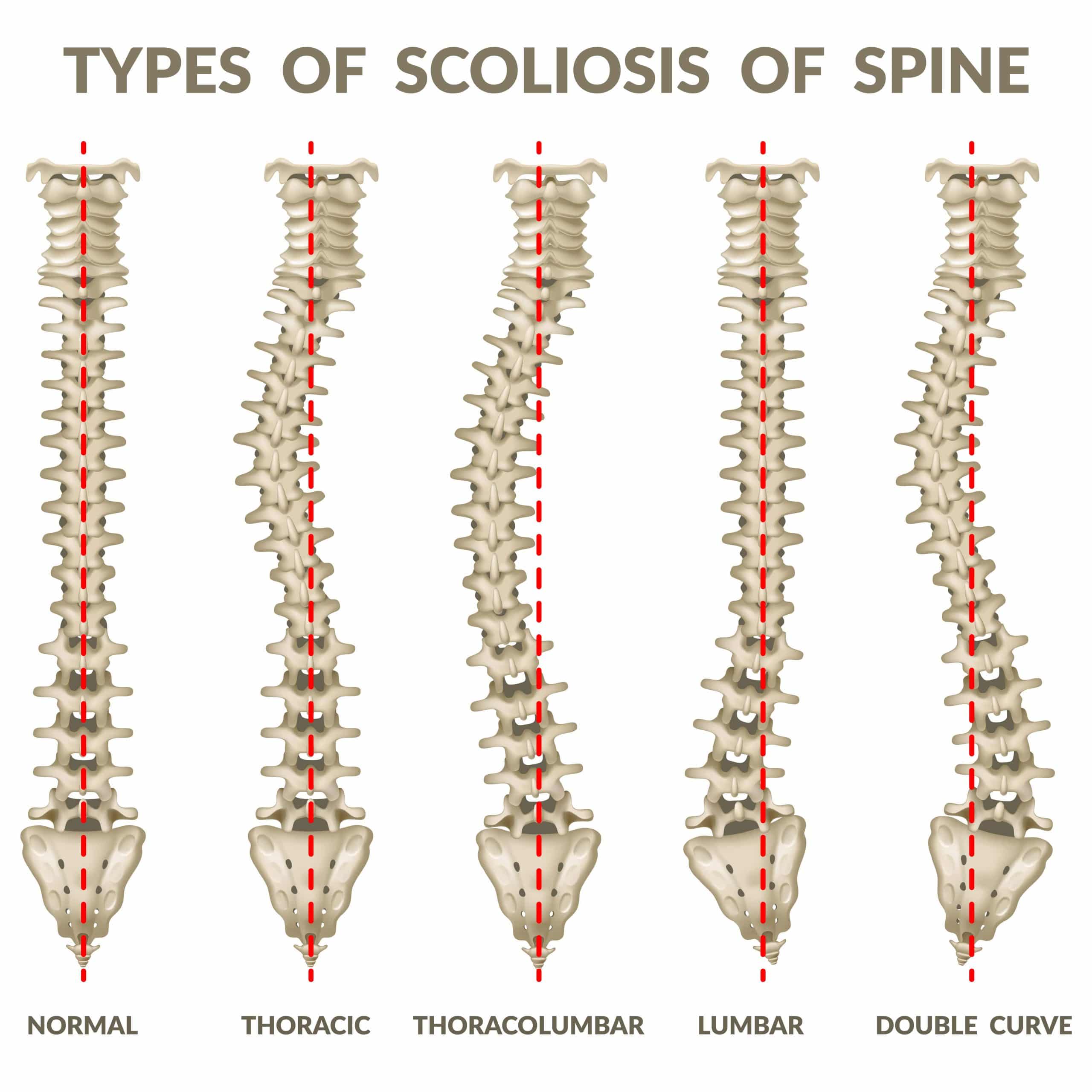 Skeletal representation of a scoliosis