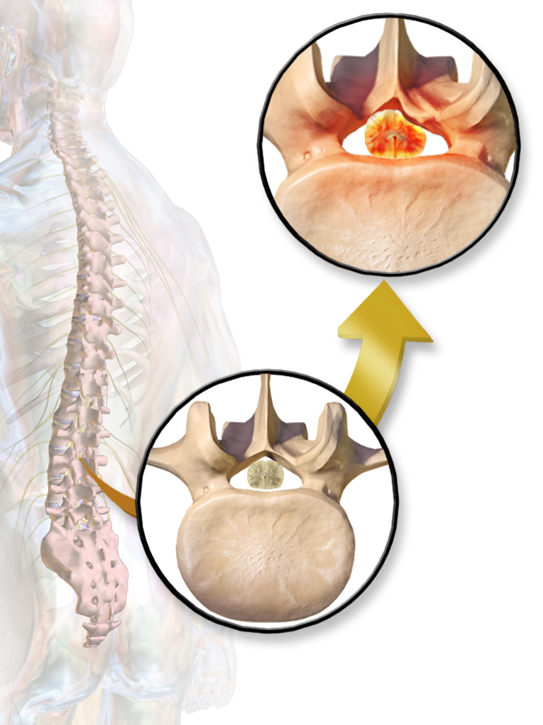 Spinal Stenosis medical illustration