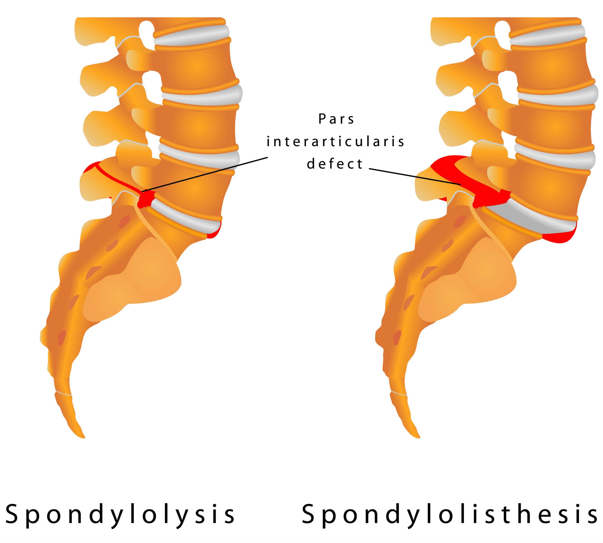 Spondylolysis medical illustration
