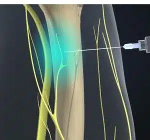 animated representation of nerve blocking 
