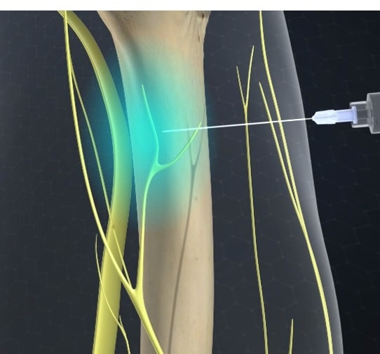 Nerve Blocks in The Woodlands and Houston HSR