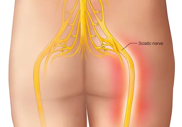 Sciatica image