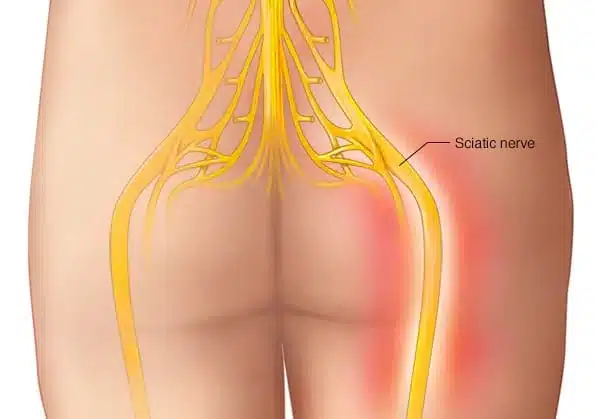 Sciatica image