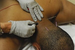 back of an African-American man undergoing dry needling therapy