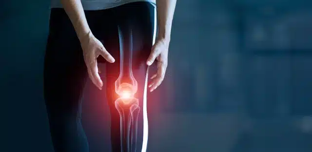 woman suffering from knee osteoarthritis, medical illustration of knee osteoarthritis.