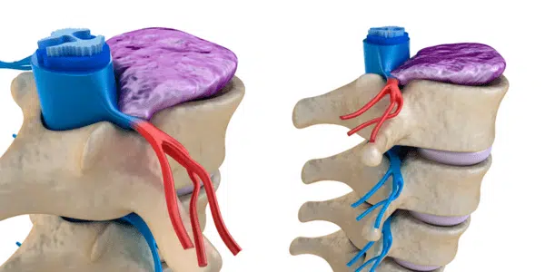 Medical illustration of a spinal cord under pressure of bulging disc.