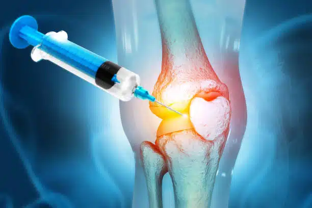 3D illustration of Human Knee Joint pain management Treatment for Osteoarthritis as a Knee Replacement Alternatives.