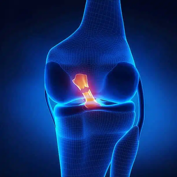 Torn Anterior Cruciate Ligament in x-ray view