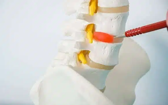 Doctor with a red pen showing a hernia disc in a skeleton.