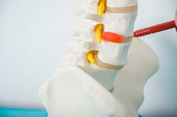 Doctor with a red pen showing a hernia disc in a skeleton.