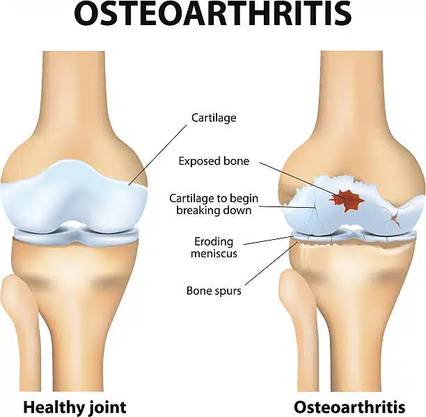 Medical illustration of a human knee bone with Osteoarthritis and healthy knee joint.