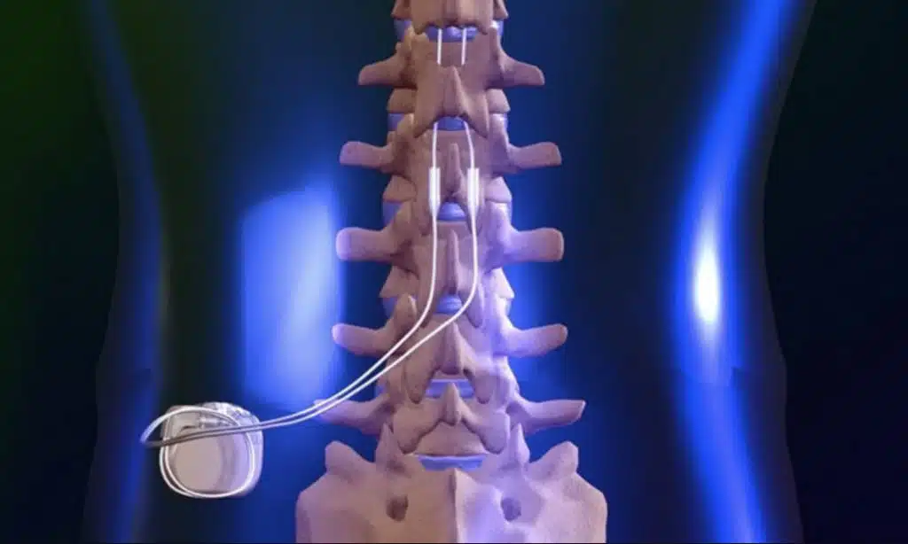 3D illustration of a spinal stimulator.