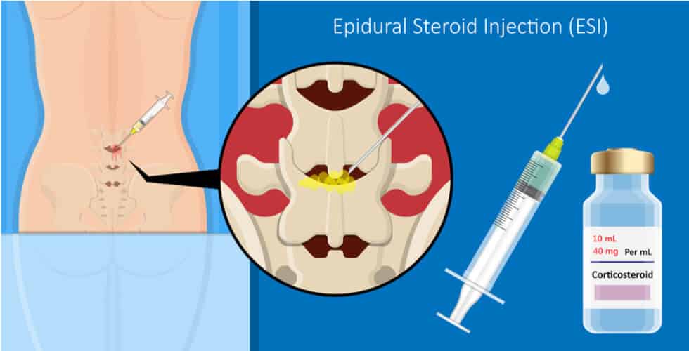 Epidural Steroid Injections illustration concept
