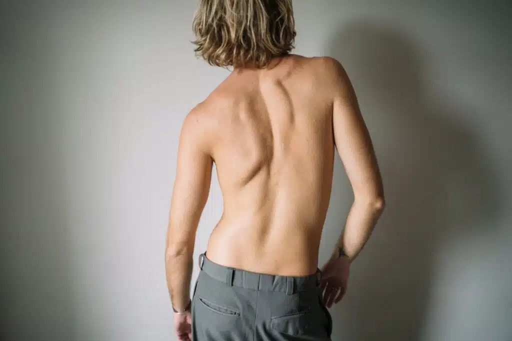 Visible spinal asymmetry and uneven shoulders associated with scoliosis