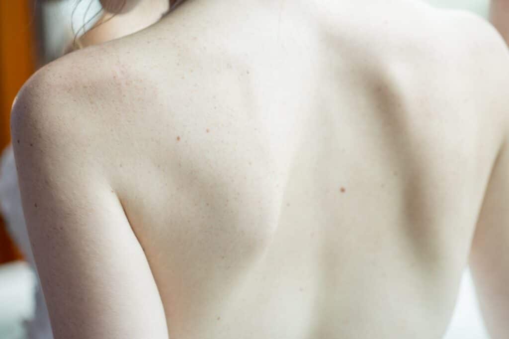 Uneven shoulder alignment as a visible sign of scoliosis