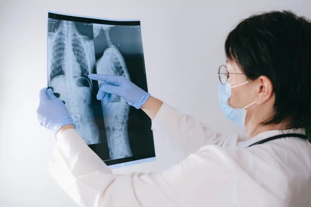 Physician reviewing scoliosis X-rays to diagnose spinal curvature in Houston