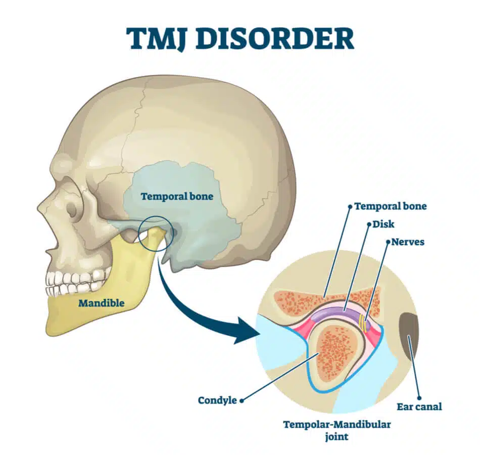 Temporomandibular Disorder (TMD)